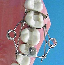 ON-Shape Dental Matrix from Dr. Walser Dental
