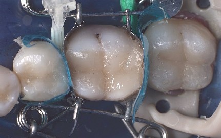 La matriz dental proporciona un modelado estético a las obturaciones de composite La matriz dental colocada en el molar crea una forma estética para la obturación de composite.