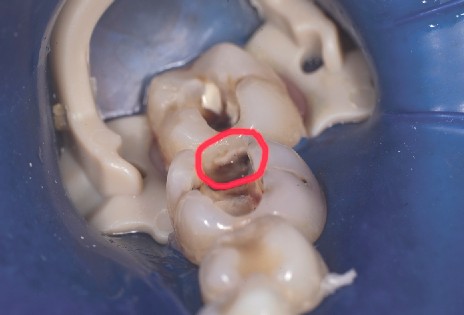 El dique de goma con la grapa para dique está colocado sobre los molares que se van a preparar. El dique de goma se coloca con la grapa para dique sobre los molares que se van a preparar y que, tras el grabado ácido, se obturarán con composite.