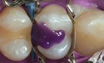Aplicación del gel de grabado con la matriz dental perfectamente ajustada al premolar Al aplicar el gel de grabado en el premolar, la matriz dental perfectamente ajustada crea una forma ideal en el diente.