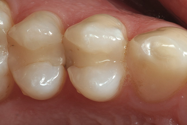 Vista oclusal de un premolar con caries Vista oclusal preoperatoria con caries recurrente en la zona linguoproximal.