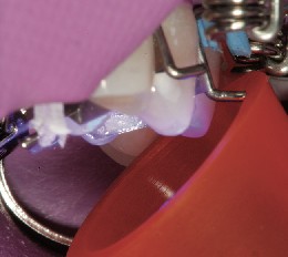 Fotopolimerización del incremento lingual con la matriz dental La fotopolimerización del incremento lingual se realiza con la matriz dental colocada.