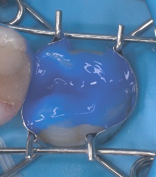 La matriz dental se ajusta perfectamente al molar durante el grabado ácido. La matriz dental rodea perfectamente el molar durante el grabado ácido y sella automáticamente la zona cervical.