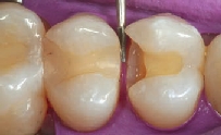 Contorneado de la obturación adyacente al premolar antes de colocar la matriz dental Antes de colocar la matriz dental, se contornea la obturación adyacente del premolar.