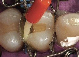 El pincel se desliza por el interior de la matriz dental perfectamente ajustada En el premolar, un pincel se desliza por el interior de una matriz dental perfectamente ajustada y distribuye el adhesivo.