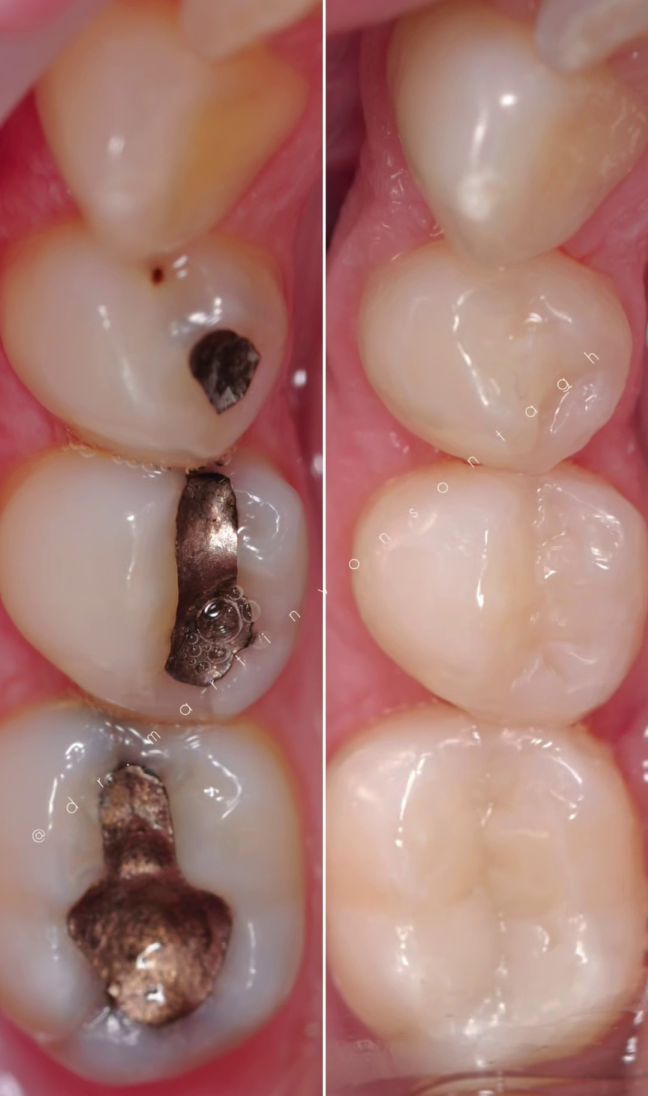Matrici dentali Walser e otturazioni in composito Matrici dentali Walser in uso, con immagini prima e dopo
