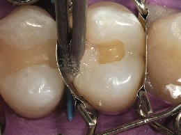 Matriz dental colocada en el premolar con un modelado perfecto de la obturación de composite terminada La matriz dental colocada en el premolar da una forma perfecta a la obturación de composite terminada.