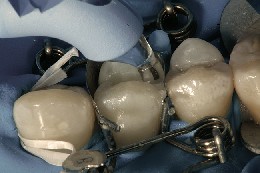 El composite se presiona contra la matriz dental perfectamente ajustada Con el instrumento Trimax se presiona el composite contra la matriz dental perfectamente ajustada.