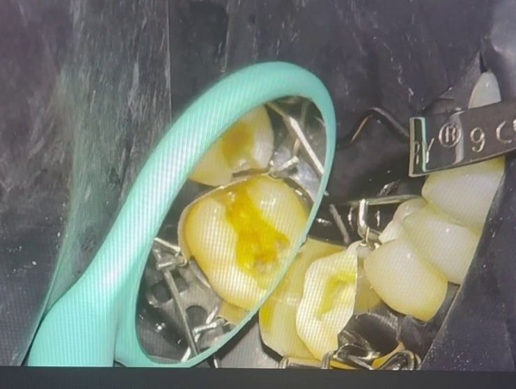 Matrice dentale ideale per otturazioni in composito Matrici dentali Walser particolarmente indicate per le otturazioni in composito
