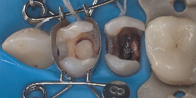 La matriz dental encaja perfectamente sobre el premolar. La matriz dental encaja perfectamente sobre el premolar y da automáticamente una forma estética a la obturación de composite que se va a colocar.