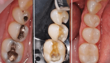 Matriz dental ideal para obturaciones de composite Las matrices dentales Walser son especialmente adecuadas para obturaciones de composite