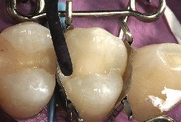 Colocación del composite en el premolar con la matriz dental perfectamente ajustada Con la matriz dental perfectamente ajustada al premolar, se aplica el composite y se modela con un instrumento.