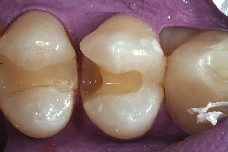 Ajuste de la preparación antes de colocar la matriz dental Antes de colocar la matriz dental, se ajusta la preparación del premolar.