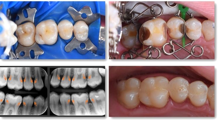Matrices dentales Walser y obturaciones de composite Matrices dentales Walser en uso, con imágenes del antes y el después