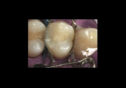 La matriz dental crea la forma perfecta para la obturación de composite terminada La matriz dental crea una forma perfecta para la obturación de composite terminada en el premolar.