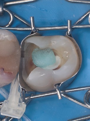 Matriz dental perfectamente ajustada al molar sobre el dique de goma La matriz dental se asienta de forma óptima sobre el molar, por encima del dique de goma, mientras se desinfecta la cavidad.