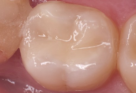 Matriz dental retirada: resultado perfecto de la obturación Superficie perfecta de la cavidad tras retirar la matriz dental Walser