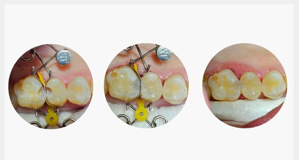 Matriz dental ideal para obturaciones de composite Matrices dentales Walser, especialmente adecuadas para obturaciones de composite
