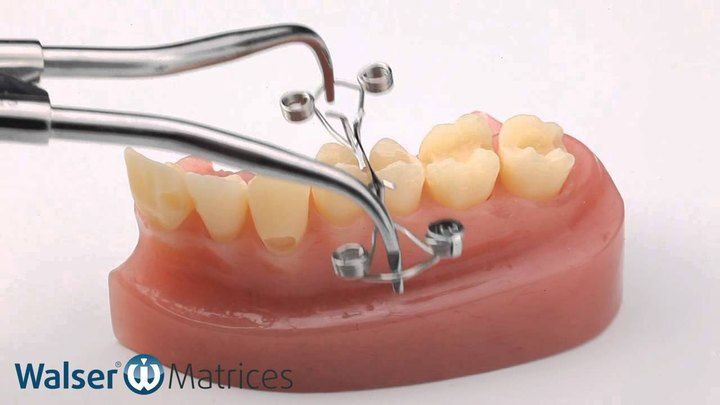 Vídeo: matriz dental Walser en forma de X durante su uso