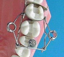 Für Endständige Zähne die ideale Zahn-Matrize, ein, klick, sitzt