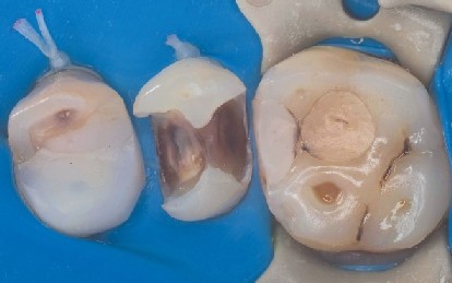Die alte Füllung ist entfernt und der Prämolar ist vorbereitet zum Anlegen der Zahn-Matrize