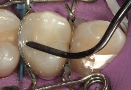 Mit Instrument wird die Compositefuellung in Zahn-Matrize geformt Mit einem Instrument wird die Compositefüllung bei eng anliegender Zahn-Matrize geformt.