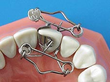 Forme en OF matrice pour dent de Dr. Walser Dental