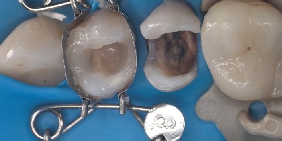 Die Zahn-Matrize von Dr. Walser Dental sitzt ideal über Kofferdam auf Praemolar und gibt automatisch eine schöne Formgebung 