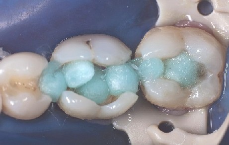 Die Molaren-Kavitaeten werden desinfiziert und vorbereitet für die Zahn-Matrizen, damit die Kompositfüllung gelegt werden kann.