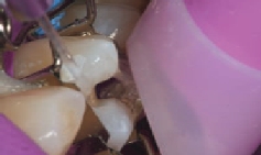 Die Zahn-Matrize am Praemolaren wird von Aetzgel befreit Das Ätzgel wird am Prämolaren und der Zahn-Matrize ausgespült.