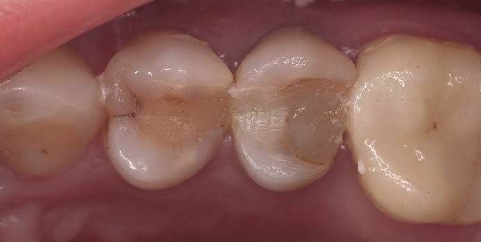 Zwei defekte Füllungen in Prämolaren die entfernt werden müssen und durch neue Kompositfüllungen ersetzt werden. 