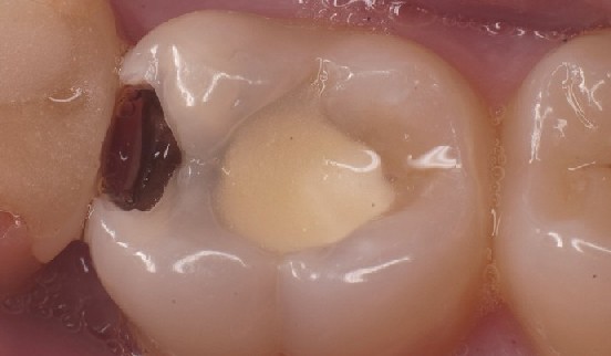 Ansicht des Molaren mit Kavität vor der Präparation von oben.