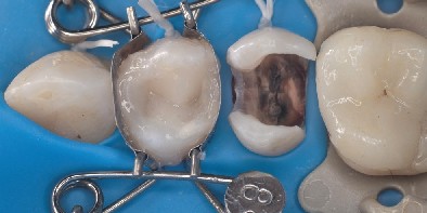 Die Zahn-Matrize sitzt auf dem Pämolar mit einer perfekten Formgebung der fertigen Compositefüllung.