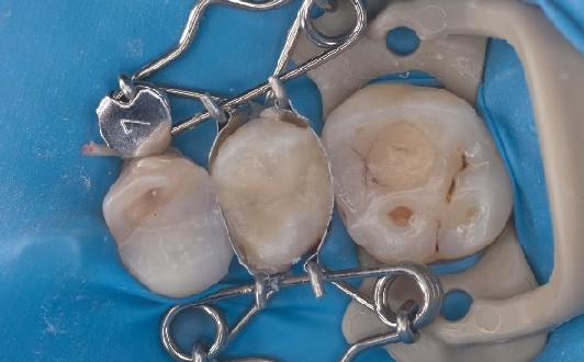 Die Zahn-Matrize ist perfekt um den Zahn gespannt und liegt automatisch an, dabei ergibt sich eine optimale Formgebung der Füllung. 