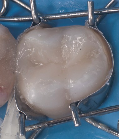 Zahn-Matrize sitzt perfekt auf Molar und bildet dabei automatisch eine schöne Formgebung der einzusetzenden Compositefüllung.