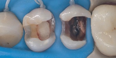 Kofferdam wird mit Zahnseide fixiert und sitzt ueber zwei praeparierten Praemolaren.