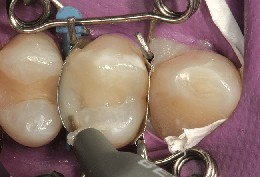 Komposit wird in Praemolar und Zahn-Matrize eingebracht Das zahnfarbene Komposit wird in den Prämolar und in die perfekt anliegende Zahn-Matrize eingebracht.