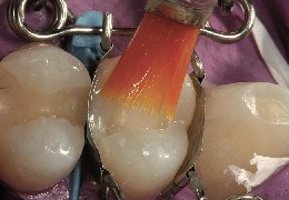 Zahn-Matrize sitzt perfekt auf Praemolar mit Komposit Die Zahn-Matrize sitzt perfekt auf Prämolar und ist mit Komposit befüllt, dabei wird das Komposite mit der Keystone Bürste geglättet.