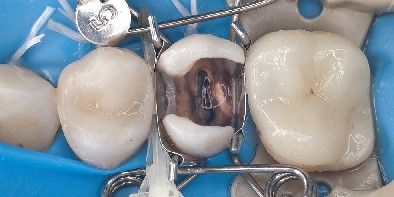 Zahn-Matrize sitzt perfekt auf Prämolar und bildet dabei automatisch eine schöne Formgebung der einzusetzenden Kompositfüllung.