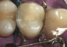 Zahn-Matrize bildet perfekte Formgebung der fertigen Kompositfuellung Die Zahn-Matrize bildet eine perfekte Formgebung der fertigen Kompositfüllung am Prämolaren