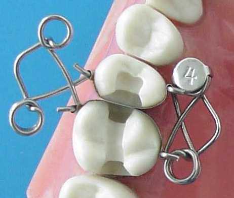 Die Walser X-Form Zahn-Matrize Nr. 4 eignet sich zum Legen von zweiflächigen Füllungen an benachbarten Zähnen