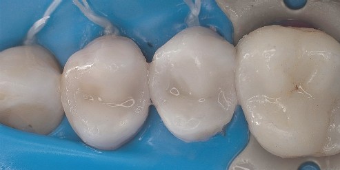 Durch Entfernung der Zahn-Matrizen zeigen sich die perfekten Kompositfüllungen, die einen idealen Kontaktpunkt aufweisen 