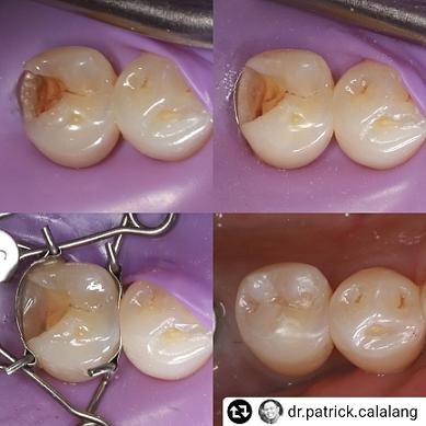 You too can work with the Walser dental matrix like Dr. Patrick Calalang, USA