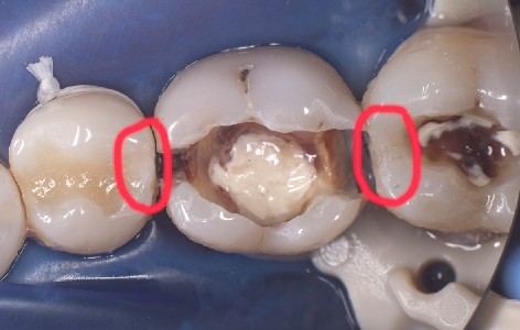 Ansicht zweier Molaren mit Karies vor der Präparation nach Einsetzen des Kofferdams.