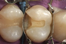 Matrize für Zahn bildet eine schöne Formgebung an Prämolar und dichtet gleichzeitg den Kavitätenboden automatisch gegen Blut und Speichel ab. 