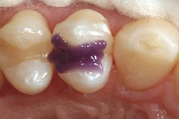 Aetzung des Praemolars vor dem Einsetzen der Zahn-Matrize Vor dem Einsetzen der Zahn-Matrize wird der Prämolar mit Ätzgel geätzt