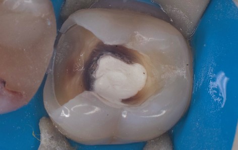 Kofferdamklammer fixiert Kofferdam ueber praepariertem Molar