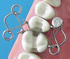 Forme en X matrice pour dent de Dr. Walser Dental