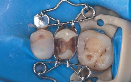 Zahn-Matrize sitzt ideal auf Prämolar, bildet automatisch eine schöne Formgebung der Füllung und dichtet zervikal sofort ab