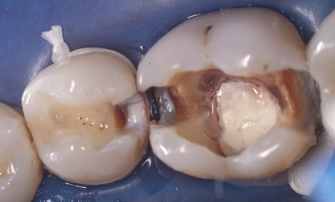 Kofferdam sitzt ueber praepariertem Praemolar und Molar, wobei der Kofferdam am Praemolar mit Zahnseide fixiert wird.